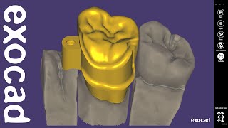 exocad Quick Guide New Attachment Feature [upl. by Eelitan]