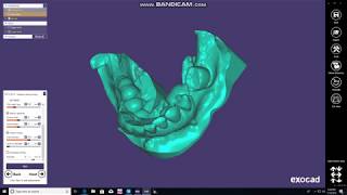 Making Models in Exocad from Trios Impressions [upl. by Anerev]