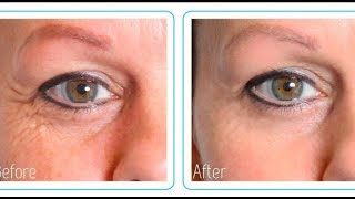 Hyaluronic Acid Before And After MY RESULTS [upl. by Haerle123]