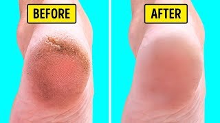 100 EFFECTIVE Hands amp Feet Whitening Remedy  With LIVE Demo [upl. by Boice]