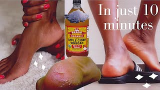 How To Make DIY Foot quotPower Peelquot Easy to make  Beverly Hills MD Beauty Tips [upl. by Nahtanhoj389]