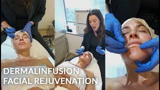 DERMALINFUSION LIVE Treatment  SilkPeel  Microdermabrasion  Dr Jason Emer [upl. by Ambrosia409]