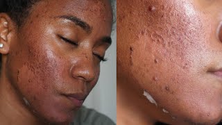 Microdermabrasion and Chemical Peel Facial at Brampton Cosmetic Clinic [upl. by Dicky276]